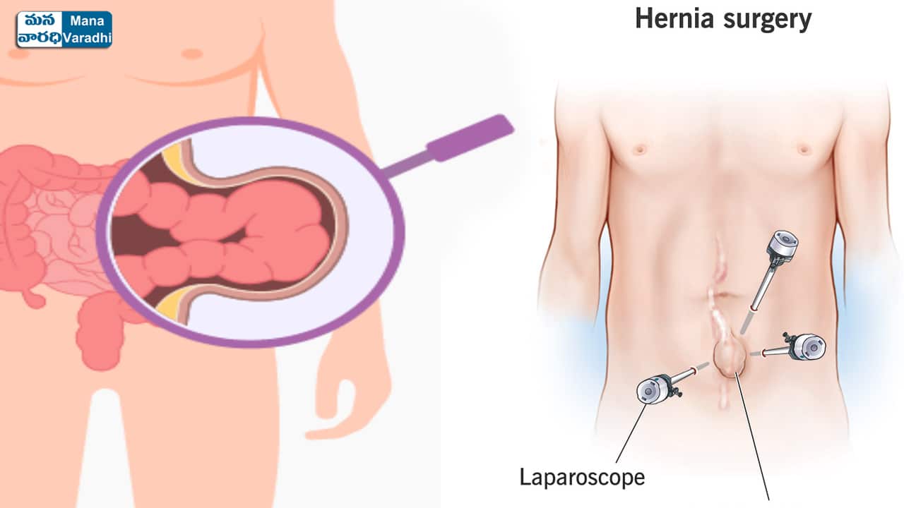 Laparoscopic Hernia