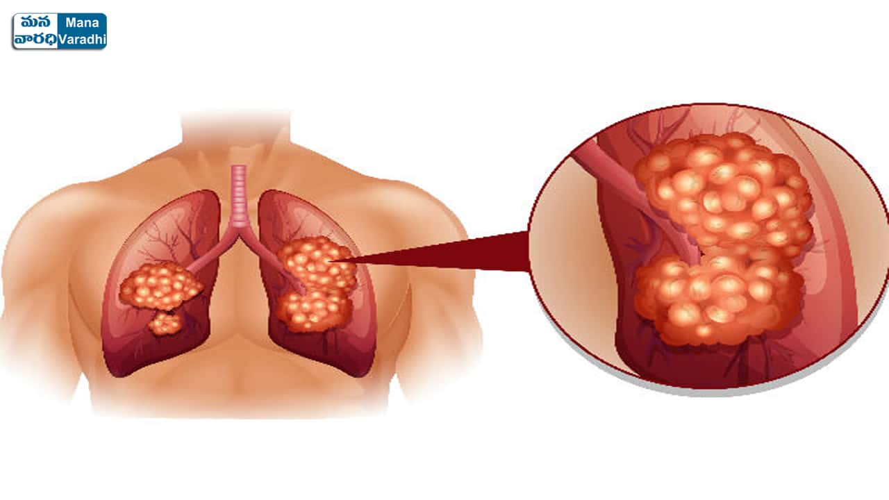 What Is Lung Fibrosis - Causes, Symptoms, Diagnosis and Treatment