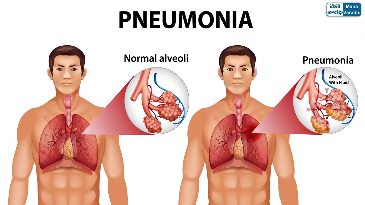 Pneumonia