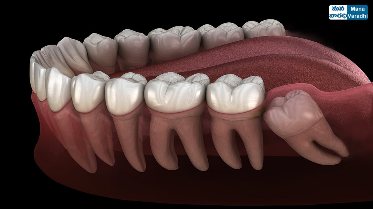 Wisdom Teeth