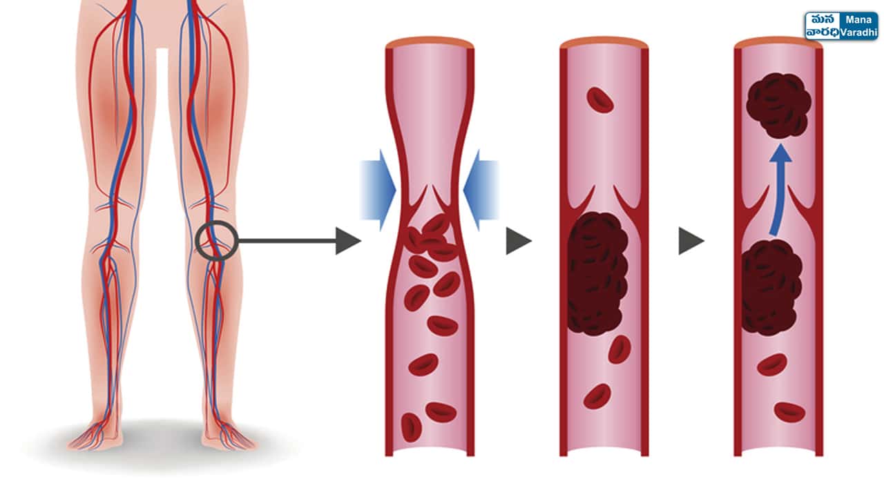 Deep Vein Thrombosis