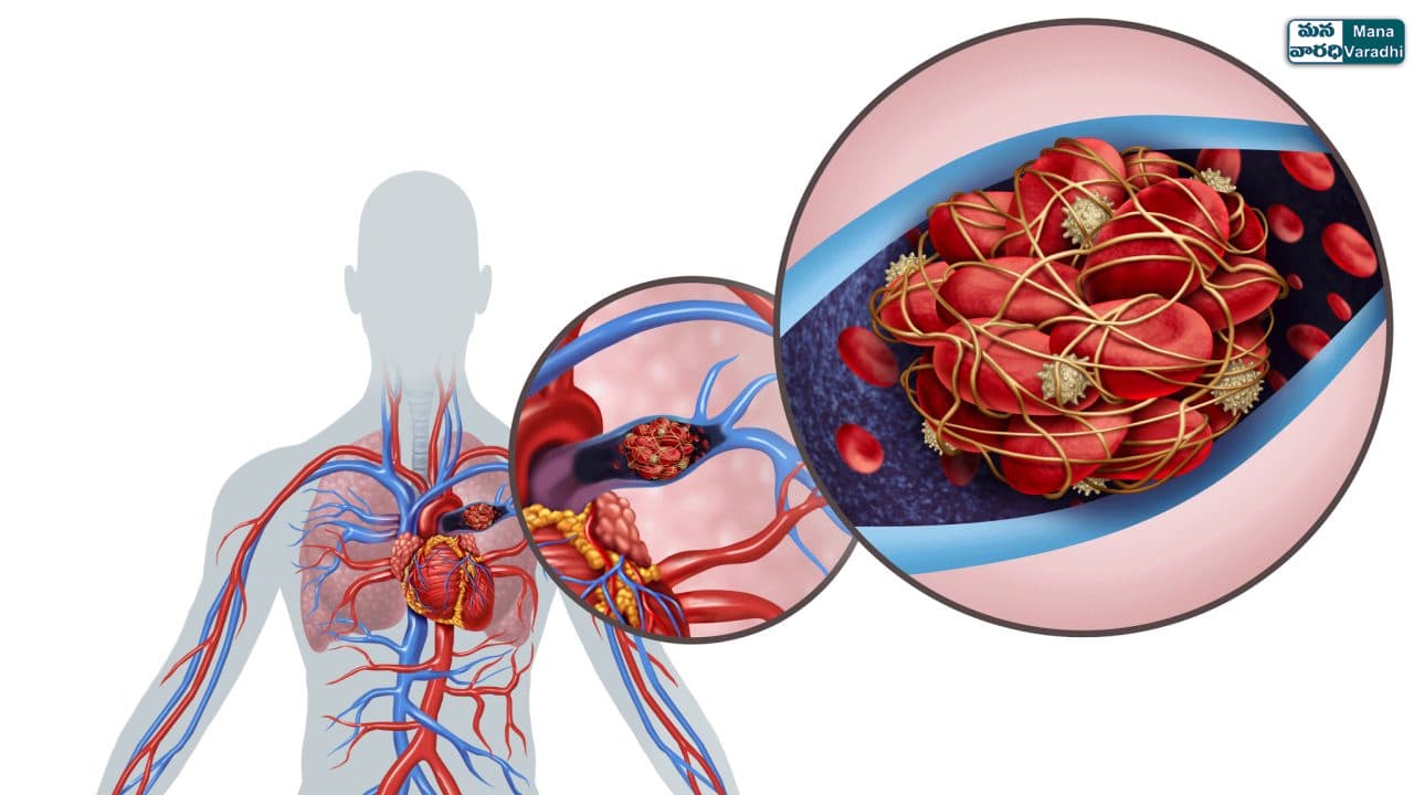 Blood Clots Health Risks