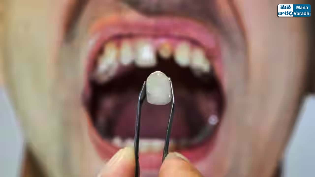 Handling Broken Tooth