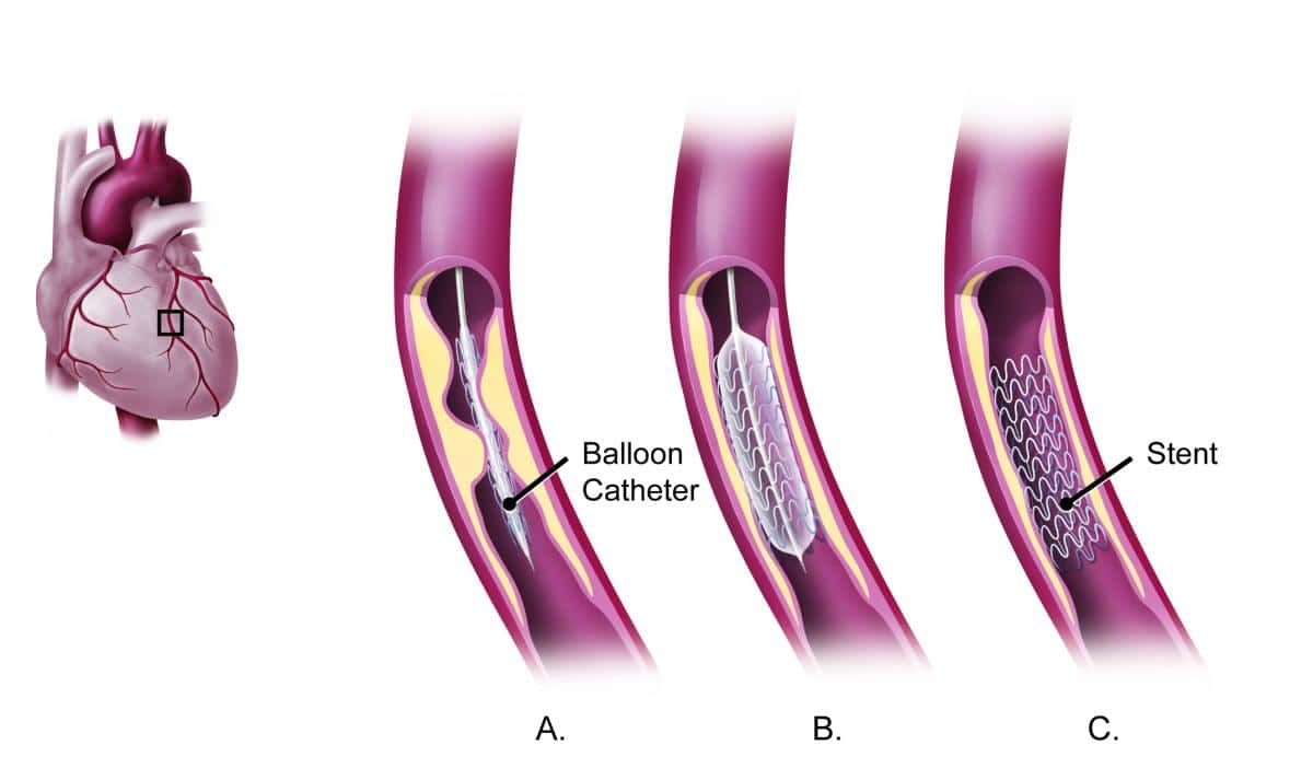 angioplasty procedure