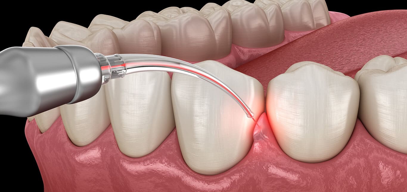 laser dentistry