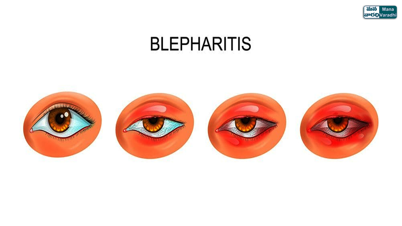 Blepharitis