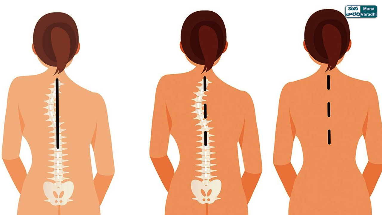 Sagittal imbalance