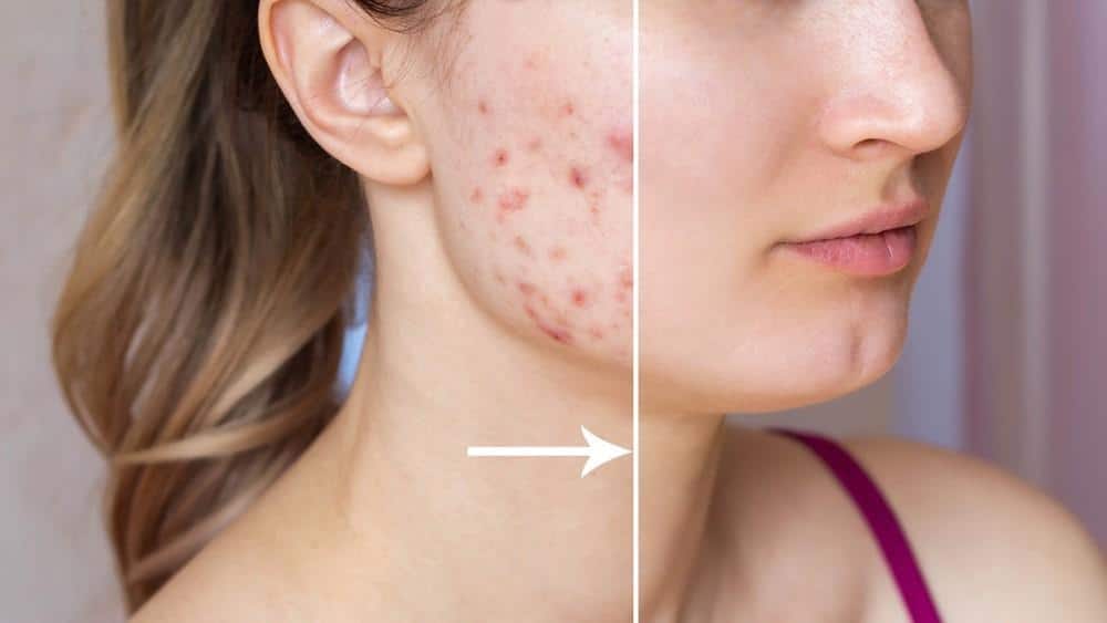 Tips for Acne Scars