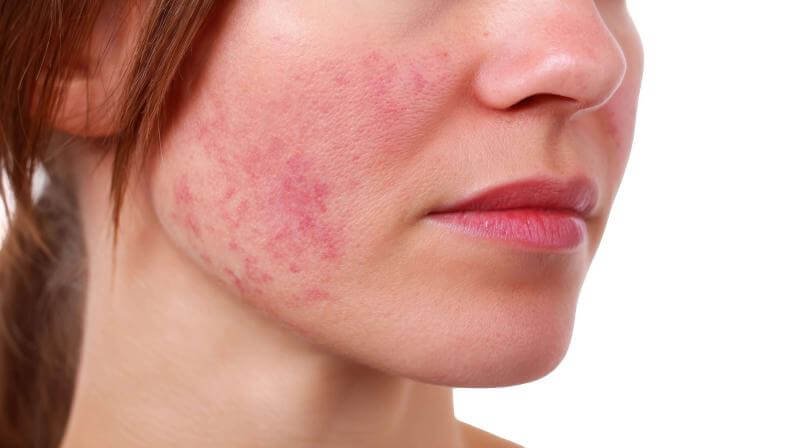 Lupus - Symptoms & causes